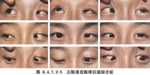 A-V综合征
