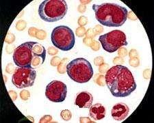 先天性红细胞生成异常性贫血