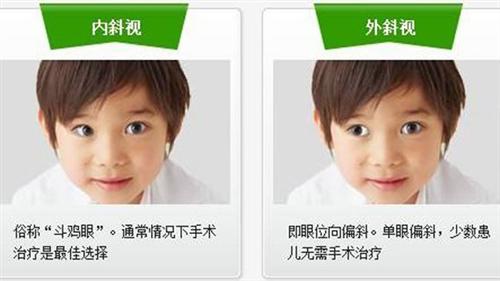 共同性外斜视