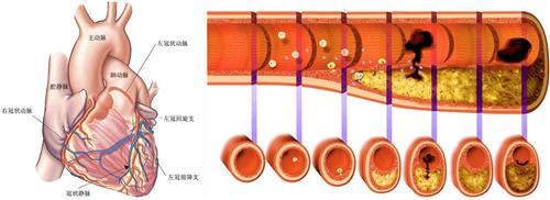 冠状动脉终止异常