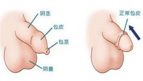包皮阴茎头炎