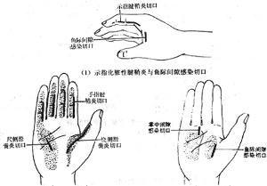 化脓性腱鞘炎