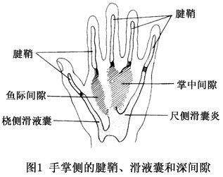化脓性腱鞘炎