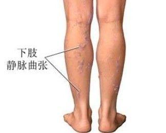单纯性下肢静脉曲张