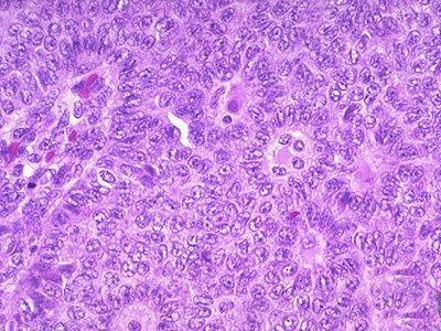 卵巢颗粒细胞瘤