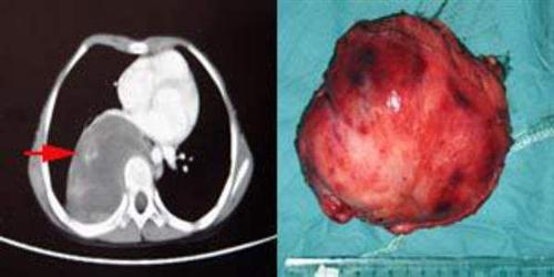 原发性纵隔感染