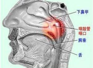 咽鼓管阻塞