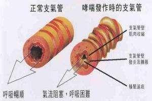 哮喘持续状态