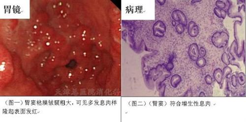嗜酸细胞性胃肠炎