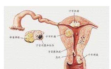外阴浸润性鳞癌