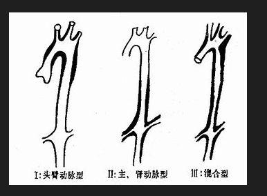 多发性大动脉炎