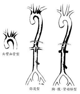 多发性大动脉炎
