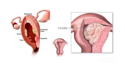 女性生殖道多部位原发癌