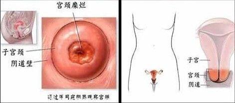 宫颈外翻