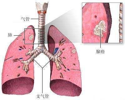 小儿衣原体肺炎