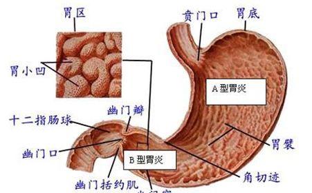 急性胃粘膜病变