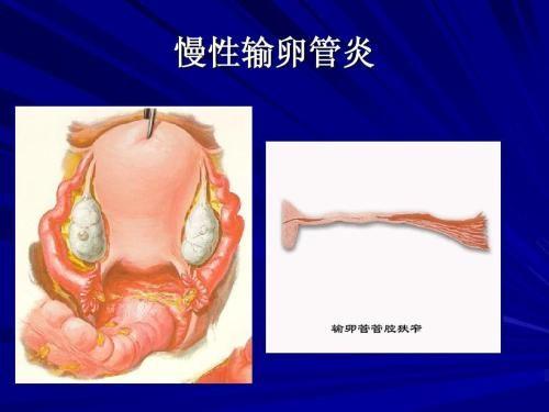 慢性输卵管炎