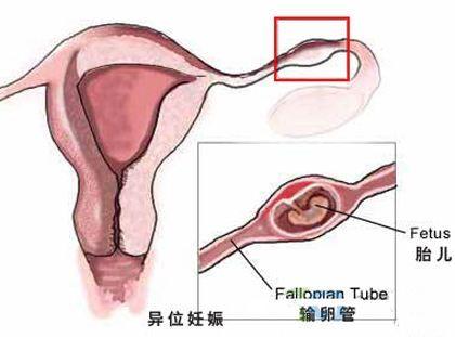 慢性输卵管炎
