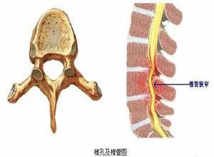 椎管狭窄症
