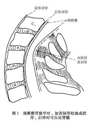 椎管狭窄症