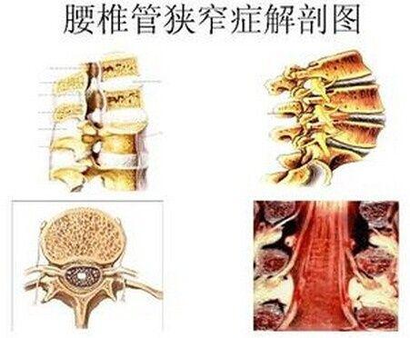 椎管狭窄症