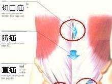 气疝