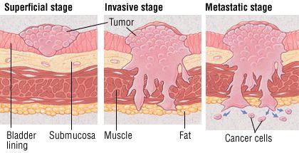 泌尿道肿瘤皮肤转移