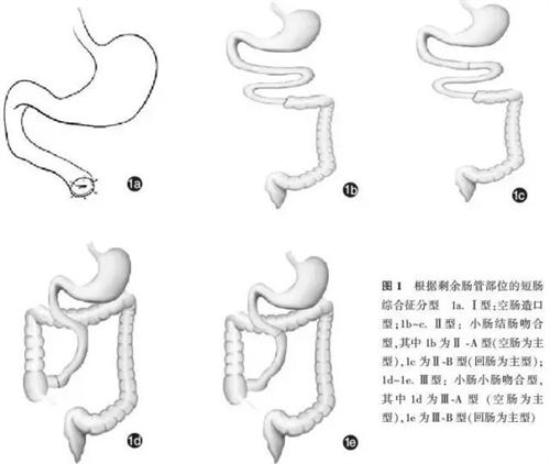 短肠综合征
