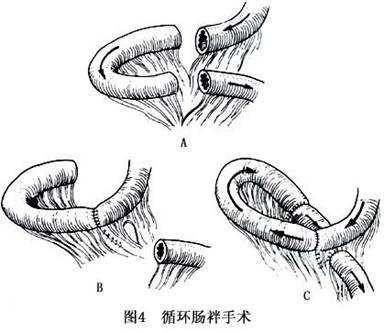 短肠综合征