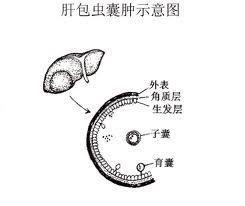 肝包虫囊肿