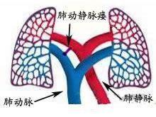 肺动静脉瘘
