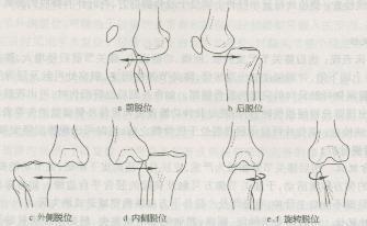 膝关节脱位