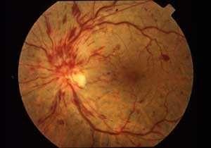 视网膜分支动脉阻塞