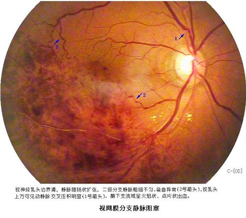 视网膜静脉阻塞