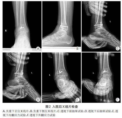 踝关节脱位