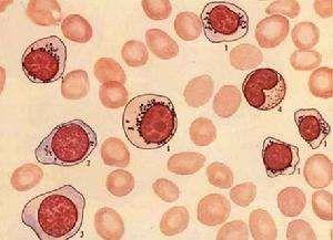 遗传性铁粒幼细胞性贫血