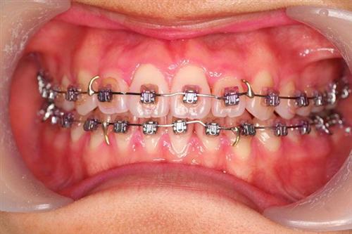 金属引起的口腔黏膜疾病