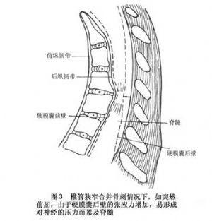 颈椎管狭窄症