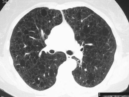 肺淋巴管平滑肌瘤