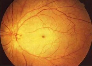 视网膜中央动脉阻塞
