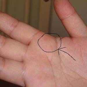 化脓性腱鞘炎