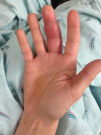 化脓性腱鞘炎