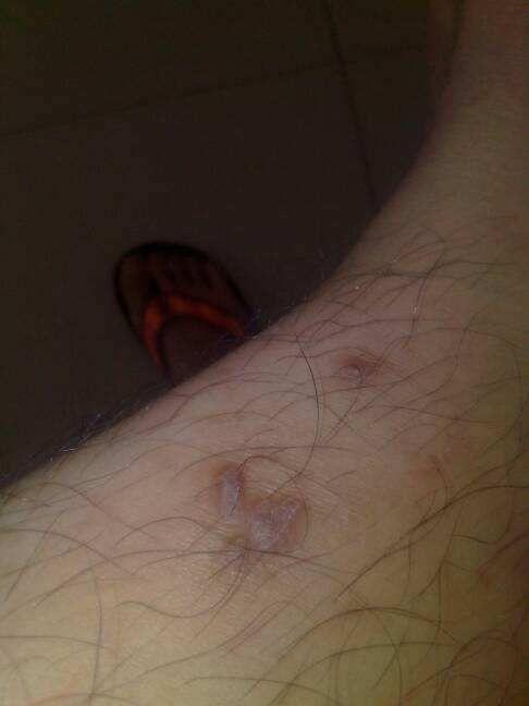 成人痒疹
