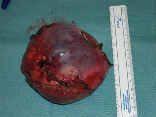 泌尿道肿瘤皮肤转移