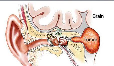 听神经鞘瘤