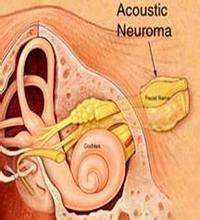 听神经鞘瘤