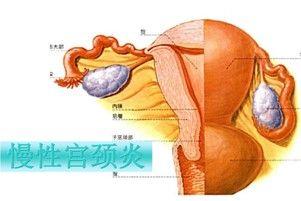 子宫颈炎