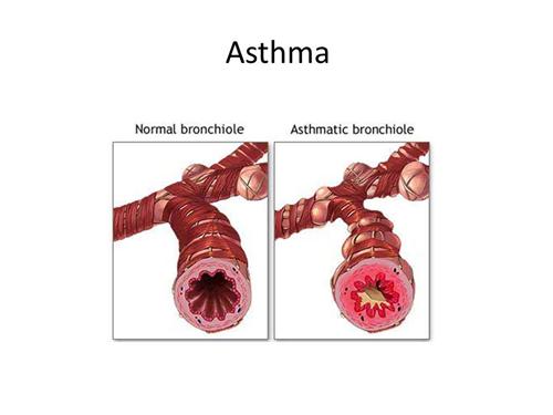 月经性哮喘
