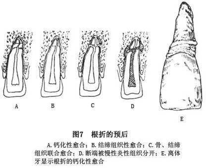 牙折