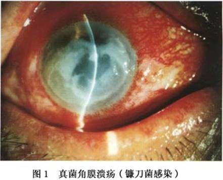 真菌性角膜炎